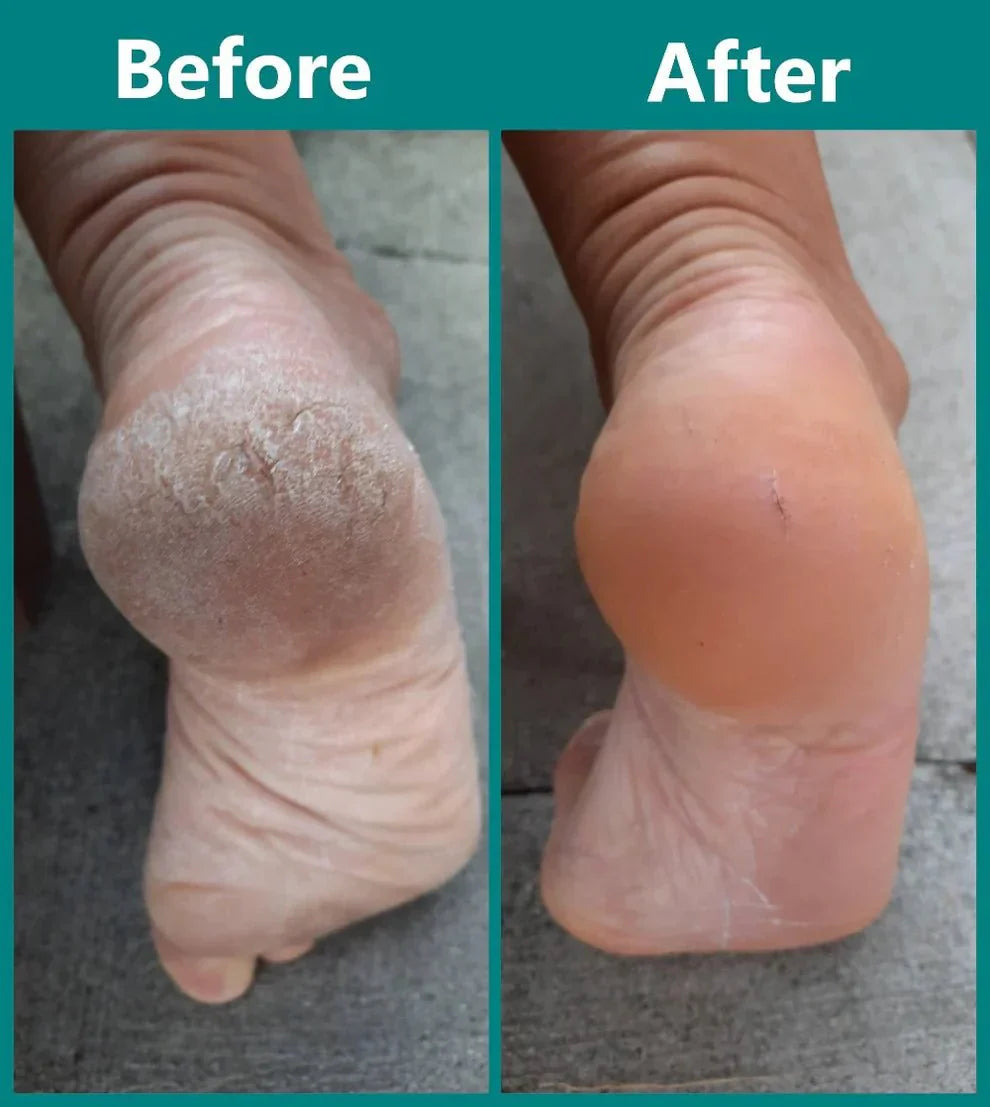 SoftTouch™ Foot Renewers — Silky Smooth Steps Instantly