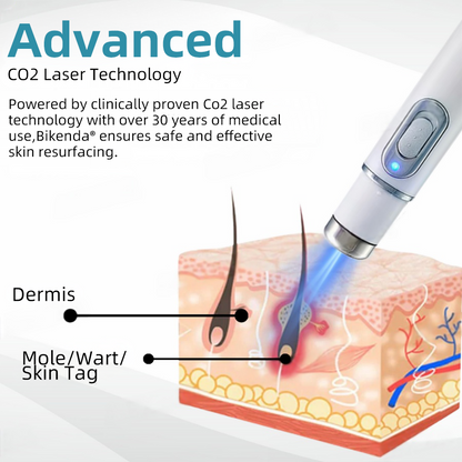 Non-Invasive Mole and Wart Removal Laser Pen Promax