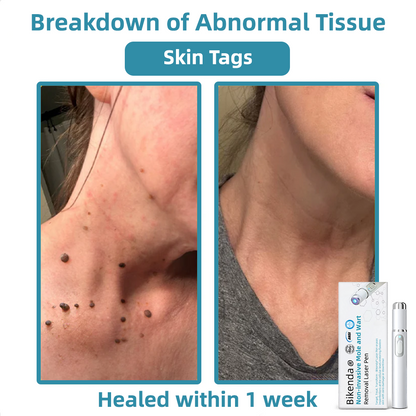 Non-Invasive Mole and Wart Removal Laser Pen Promax